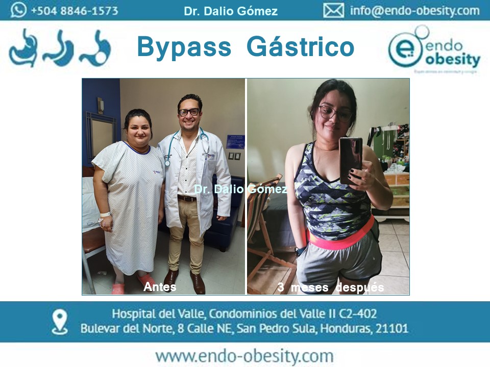 Bypass Gástrico